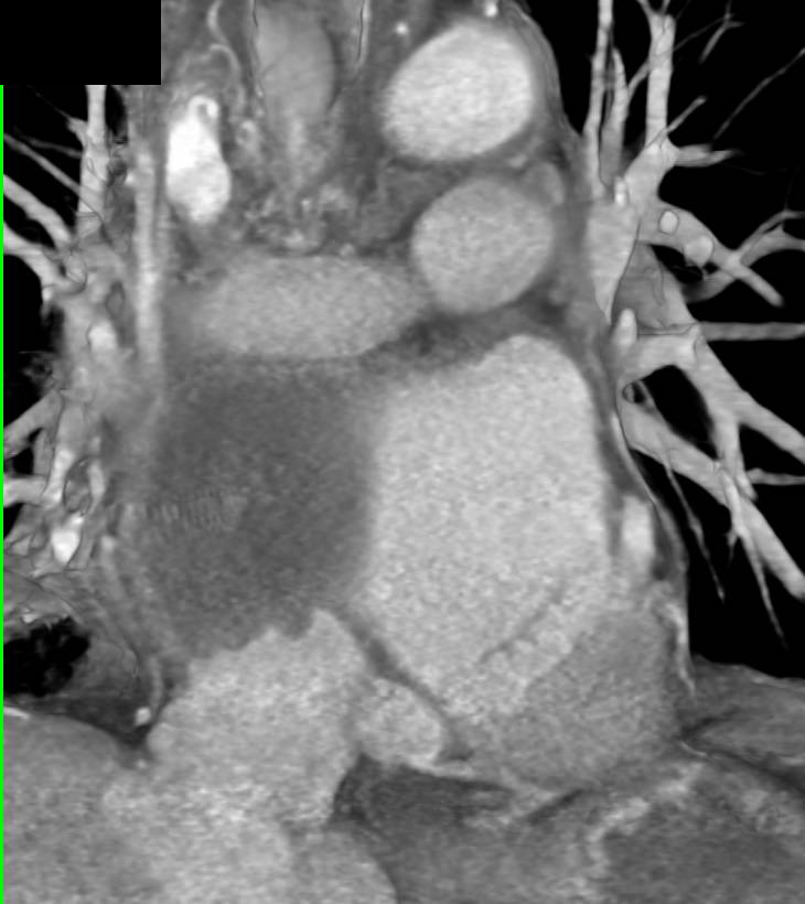 Cardiac Angiosarcoma - CTisus CT Scan