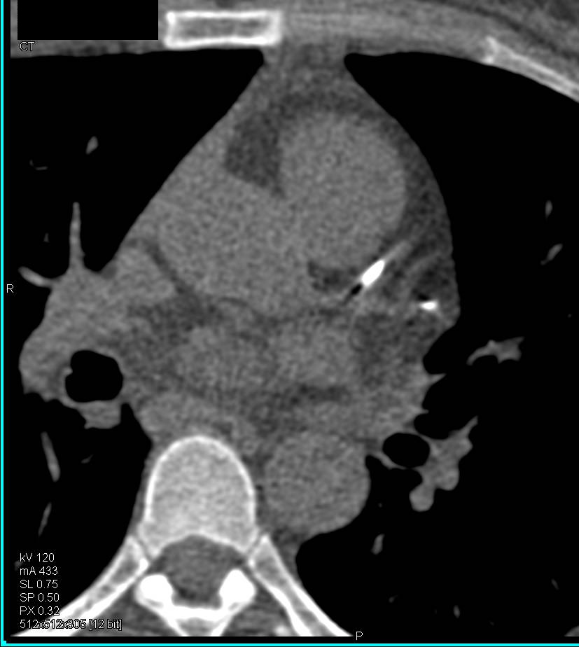 CCTA: Elevated Calcium Score as well as Mixed Plaque with no Critical Stenosis - CTisus CT Scan