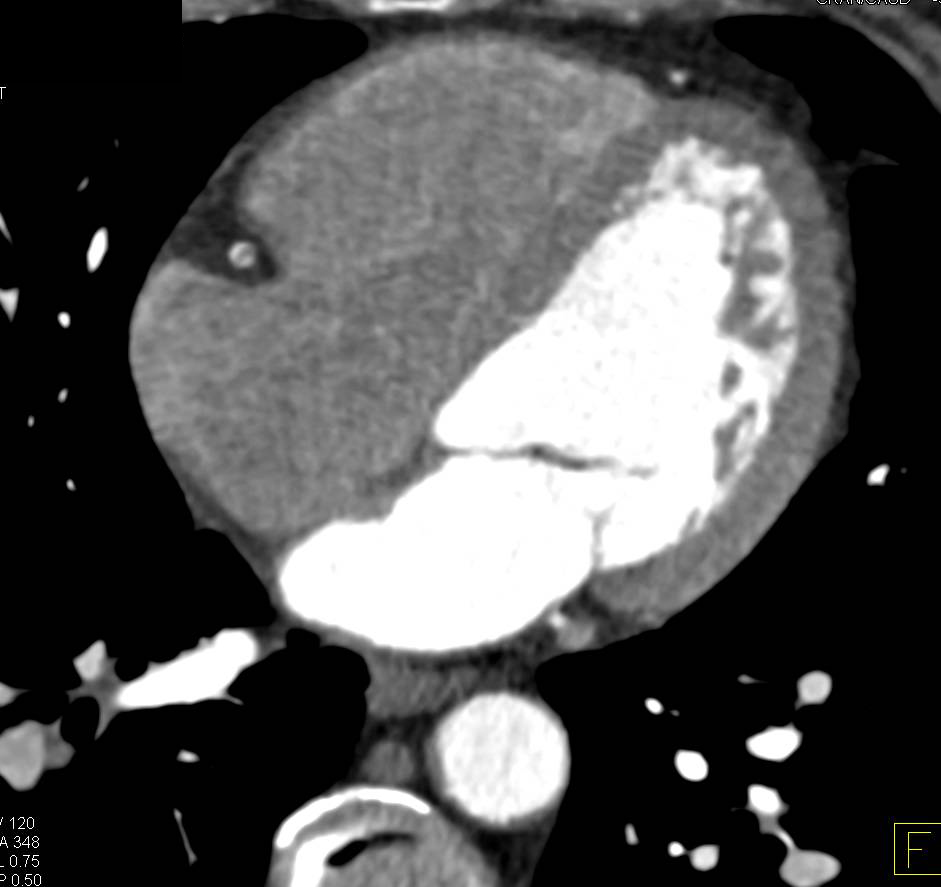 CCTA: Multivessel Disease with Mixed Plaque but with a Greater Than 70% Stenosis in the Right Coronary Artery (RCA) - CTisus CT Scan