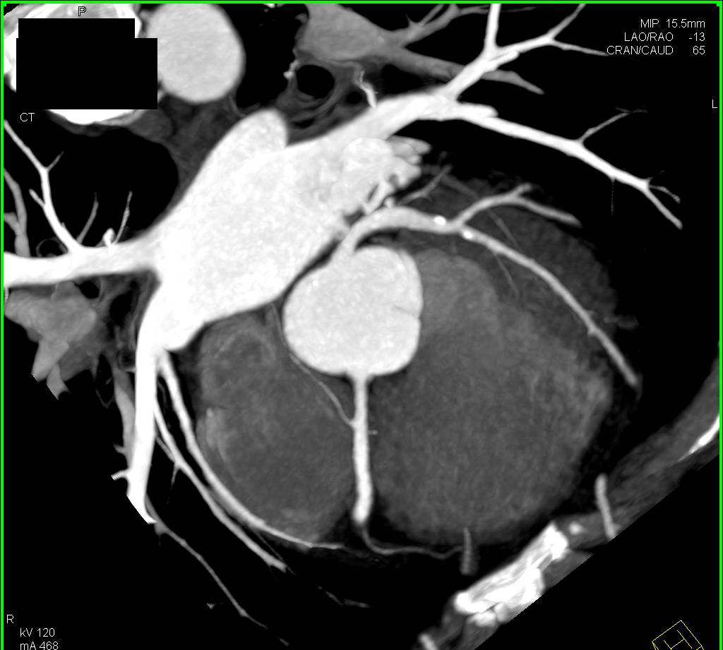 CCTA: Coronary Artery Disease with Mixed Plaque - CTisus CT Scan