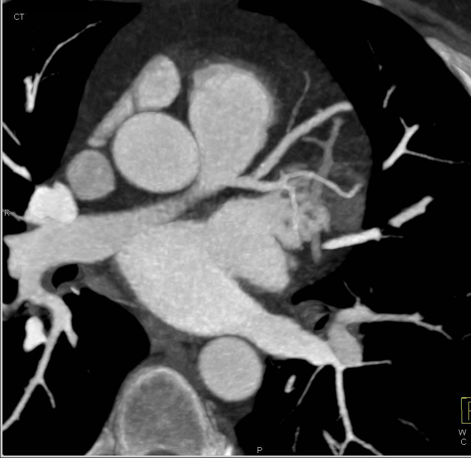 CCTA: Normal Chamber Size with Minimal Plaque - CTisus CT Scan