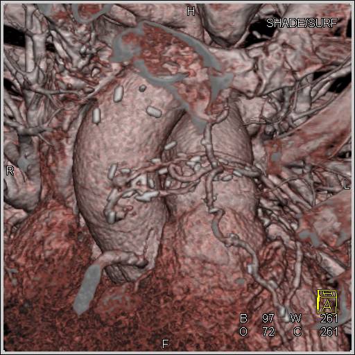 Coronary Artery Bypass Graft (CABG) with Venous Bypass Grafts and Left Internal Mammary Artery (LIMA) Graft - CTisus CT Scan