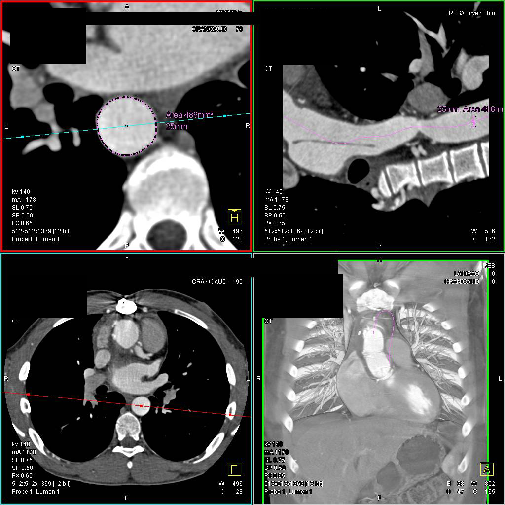 Complex Cardiac Surgery with Ascending Order Repair. Coarctation of the Aorta, and Increased Flow through the Internal Mammary Arteries - CTisus CT Scan