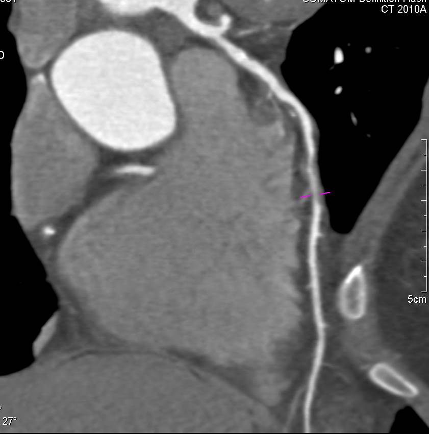 CCTA: Greater than 50% Left Anterior Descending Coronary Artery (LAD) Stenosis - CTisus CT Scan