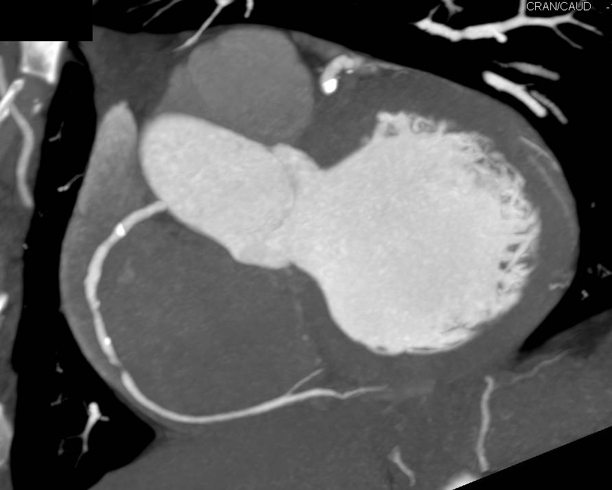 CCTA: Critical Right Coronary Artery (RCA) Stenosis in Multiple Views and Projections - CTisus CT Scan