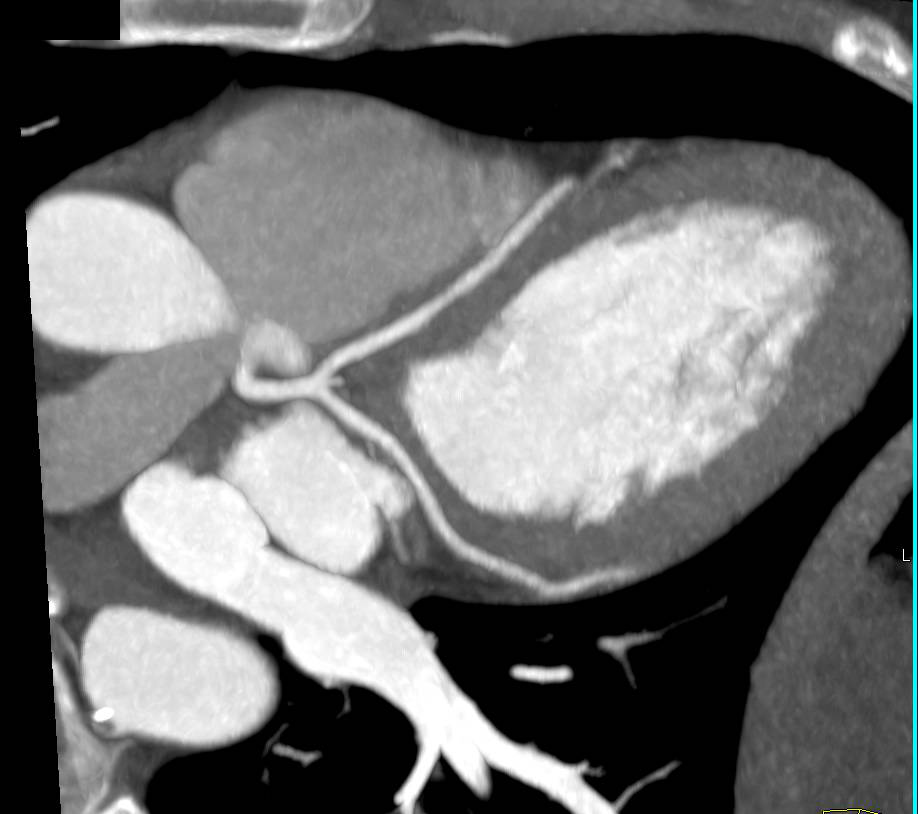 CCTA: Normal Left Anterior Descending Coronary Artery (LAD) - CTisus CT Scan