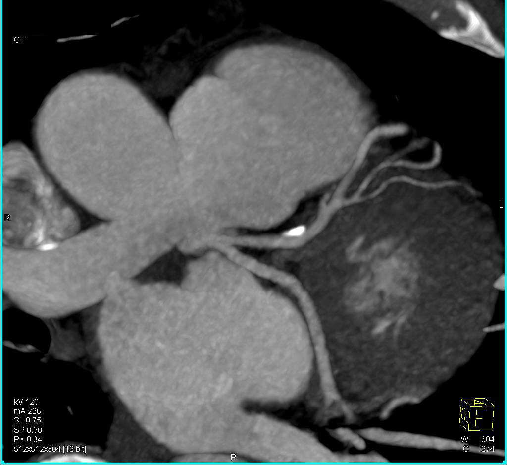 CCTA: Left Anterior Descending Coronary Artery (LAD) Plaque Without Critical Stenosis - CTisus CT Scan