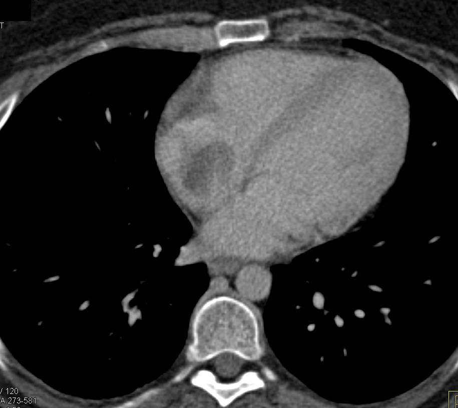 Right Atrial Thrombus that Calcifies In Time - CTisus CT Scan