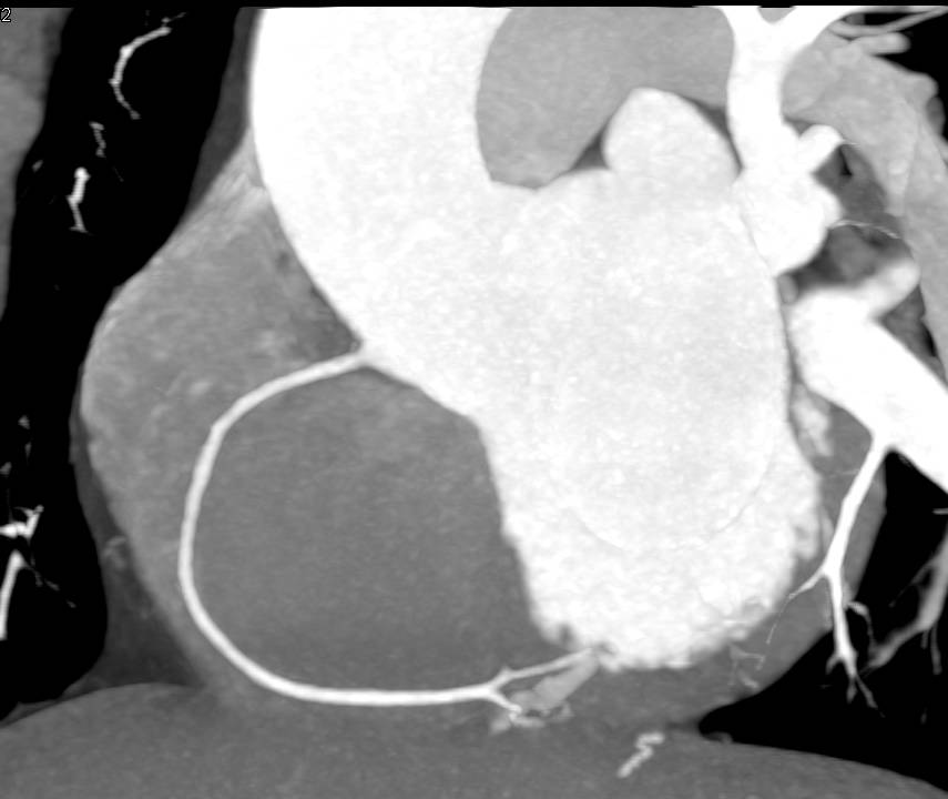 CCTA: Coronary Artery Disease with Calcified Plaque Left Anterior Descending Coronary Artery (LAD) - CTisus CT Scan