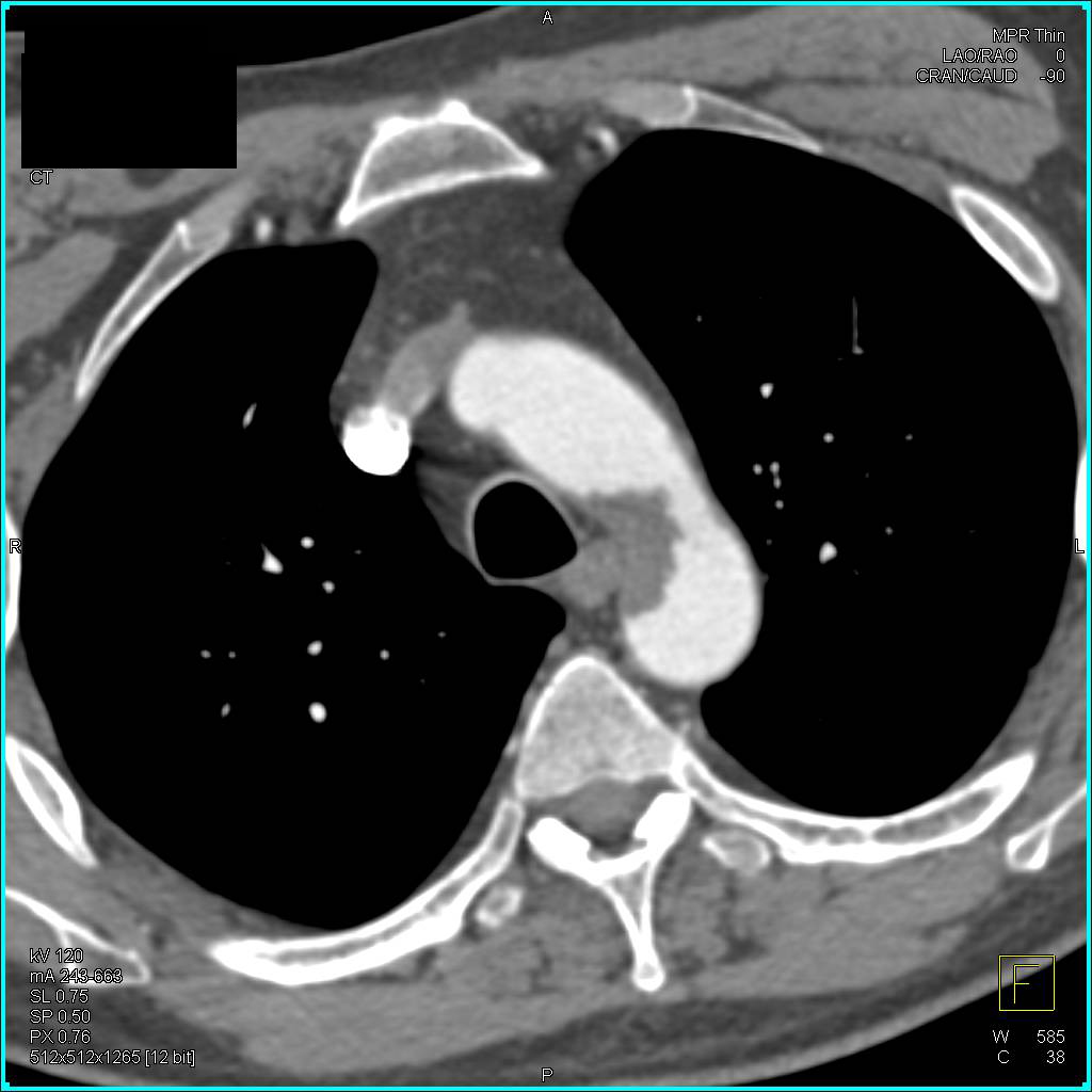 Clot in Aortic Arch - CTisus CT Scan