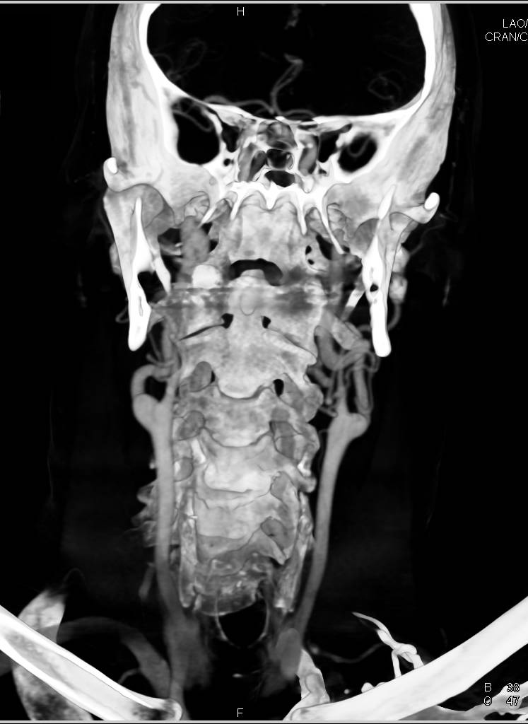 Loeys-Dietz Syndrome with Ectatic Carotid Arteries and Repair of Aortic Root with Reimplanted Coronary Arteries - CTisus CT Scan