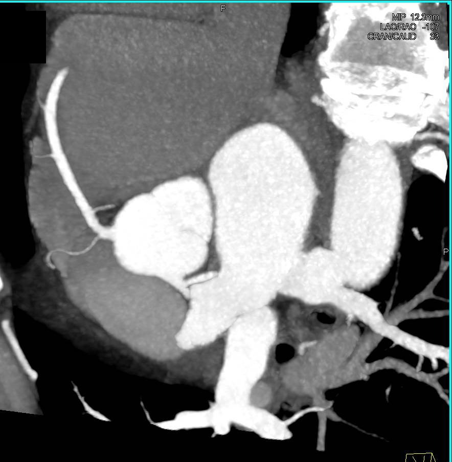 CCTA: Normal Left Anterior Descending Coronary Artery (LAD) and Right Coronary Artery (RCA) - CTisus CT Scan