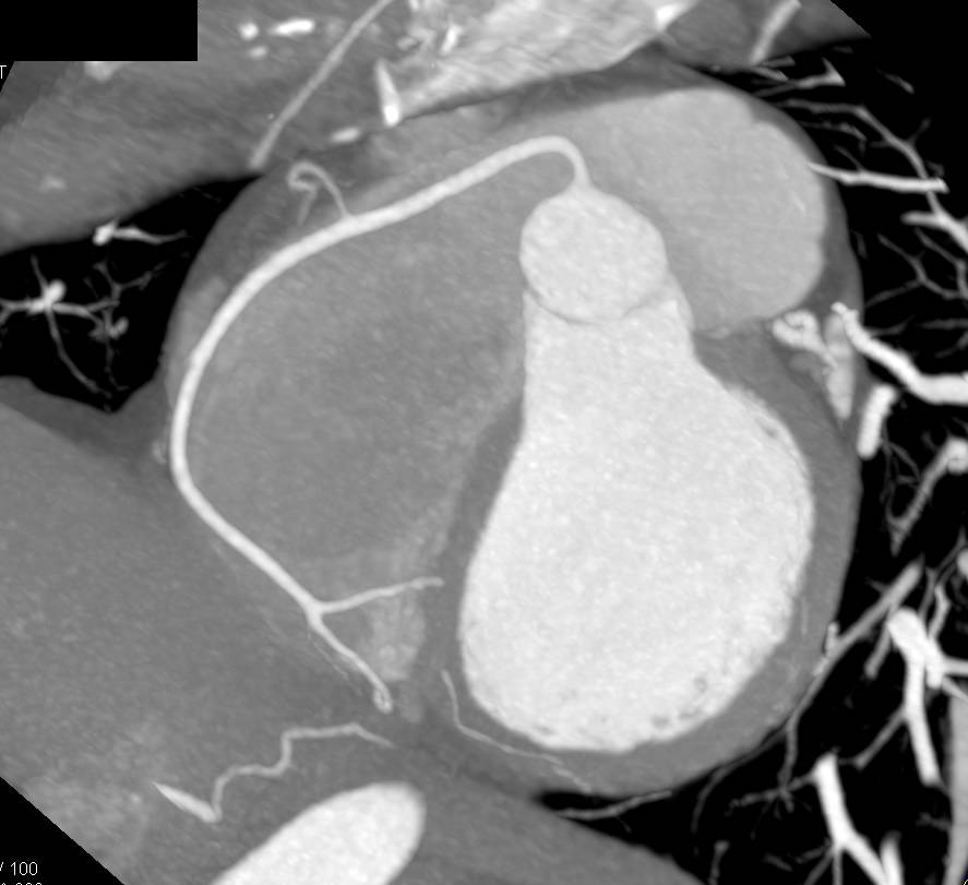 CCTA: Normal Coronary CT Angiogram - CTisus CT Scan