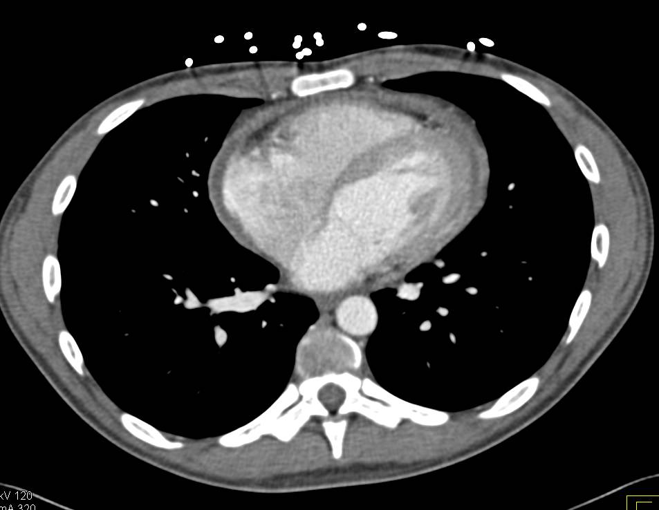 Pericardial Thickening due to Chronic Pericarditis - CTisus CT Scan