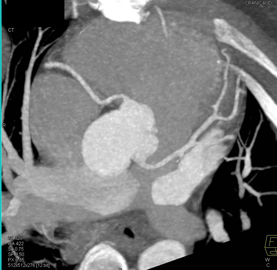 CCTA: Normal Coronary Arteries - CTisus CT Scan