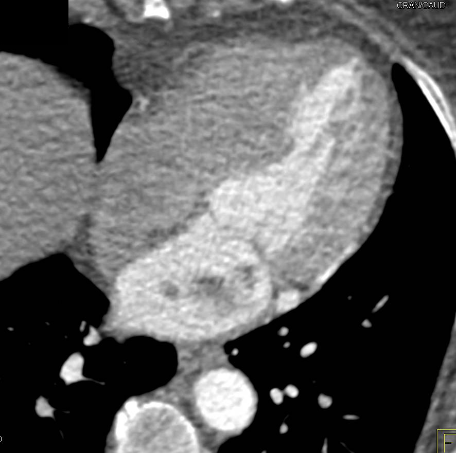 Unusual Appearance of a Left Atrial Myxoma - CTisus CT Scan