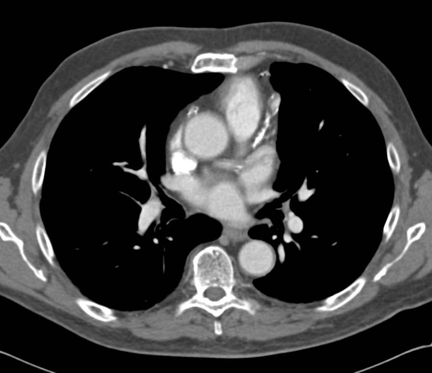 Focal Aneurysm of the Left Anterior Descending Coronary Artery (LAD) - CTisus CT Scan