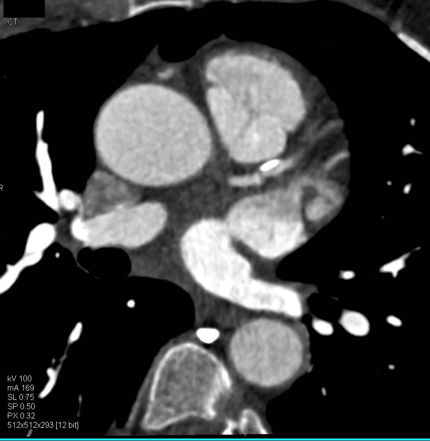 Calcified Plaque in the Left Anterior Descending Coronary Artery (LAD) Without Critical Stenosis - CTisus CT Scan