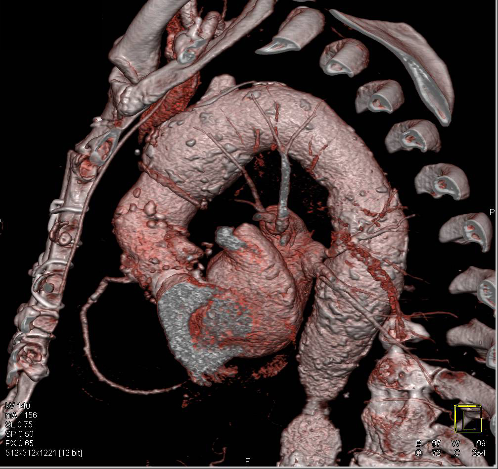 Aortic Root and Ascending Aorta Repair - CTisus CT Scan