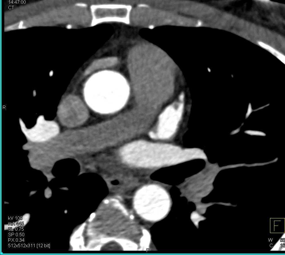 CCTA with Left Anterior Descending Artery (LAD) and Circumflex Both Arising Directly off the Left Cusp. The 3D also Nicely Defines in 3D the Left Atrial Appendage - CTisus CT Scan