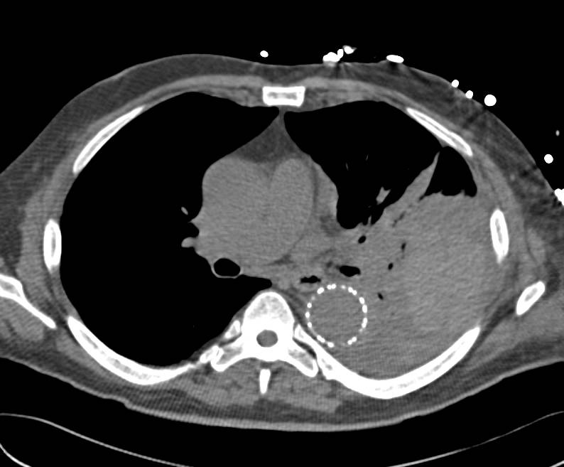 Pulmonary Artery Pseudoaneurysm in Patient with Endovascular Aortic Stent - CTisus CT Scan