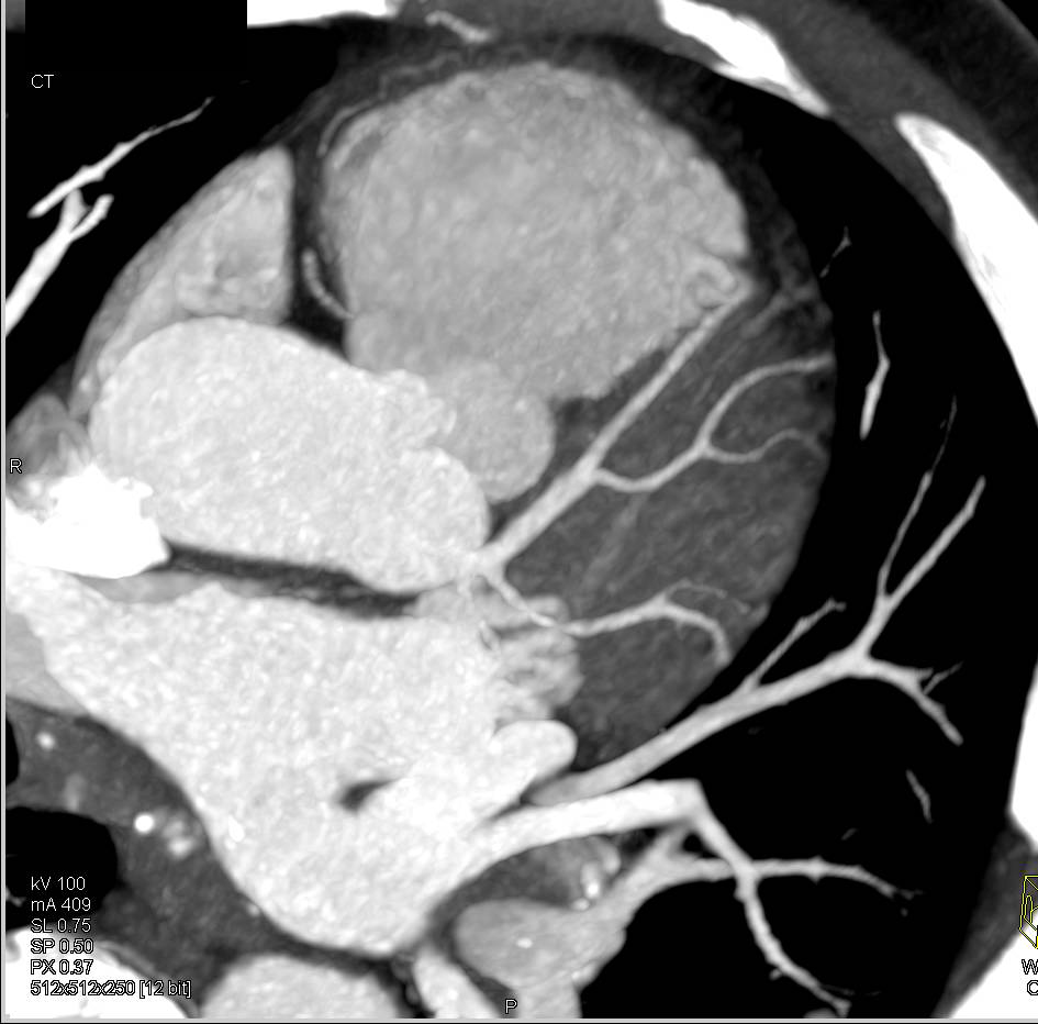 CCTA: Normal Coronary CT Angiogram - CTisus CT Scan