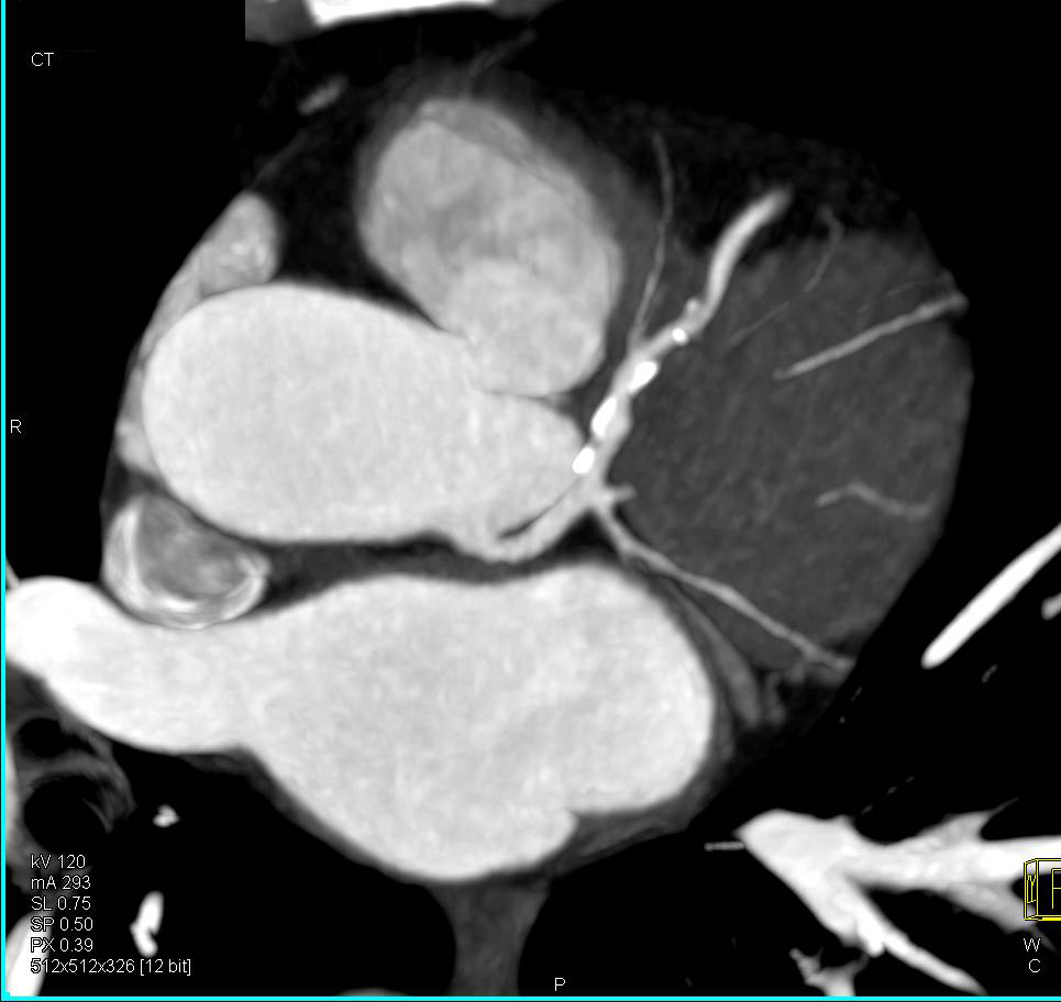 CCTA: Multiple Left Anterior Descending Coronary Artery (LAD) Plaques - CTisus CT Scan