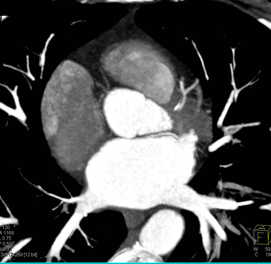 CCTA: Circumflex Coronary Artery Arises off the Right Cusp. Left Anterior Descending Coronary Artery (LAD) Plaque also seen. - CTisus CT Scan