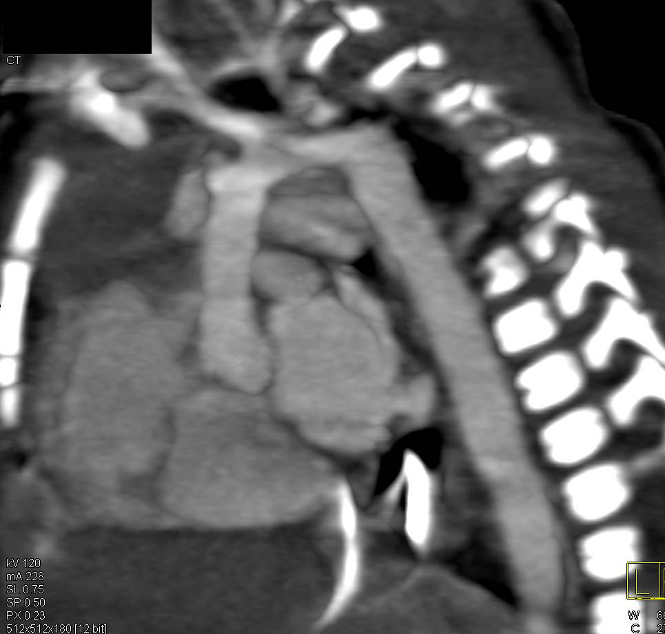Coarctation of the Aorta - CTisus CT Scan