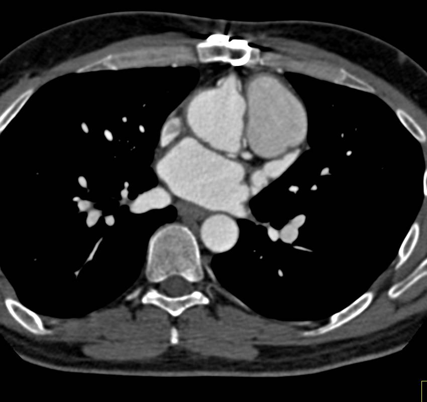 Aortic Root Repair with Reimplantation of the Coronary Arteries - CTisus CT Scan