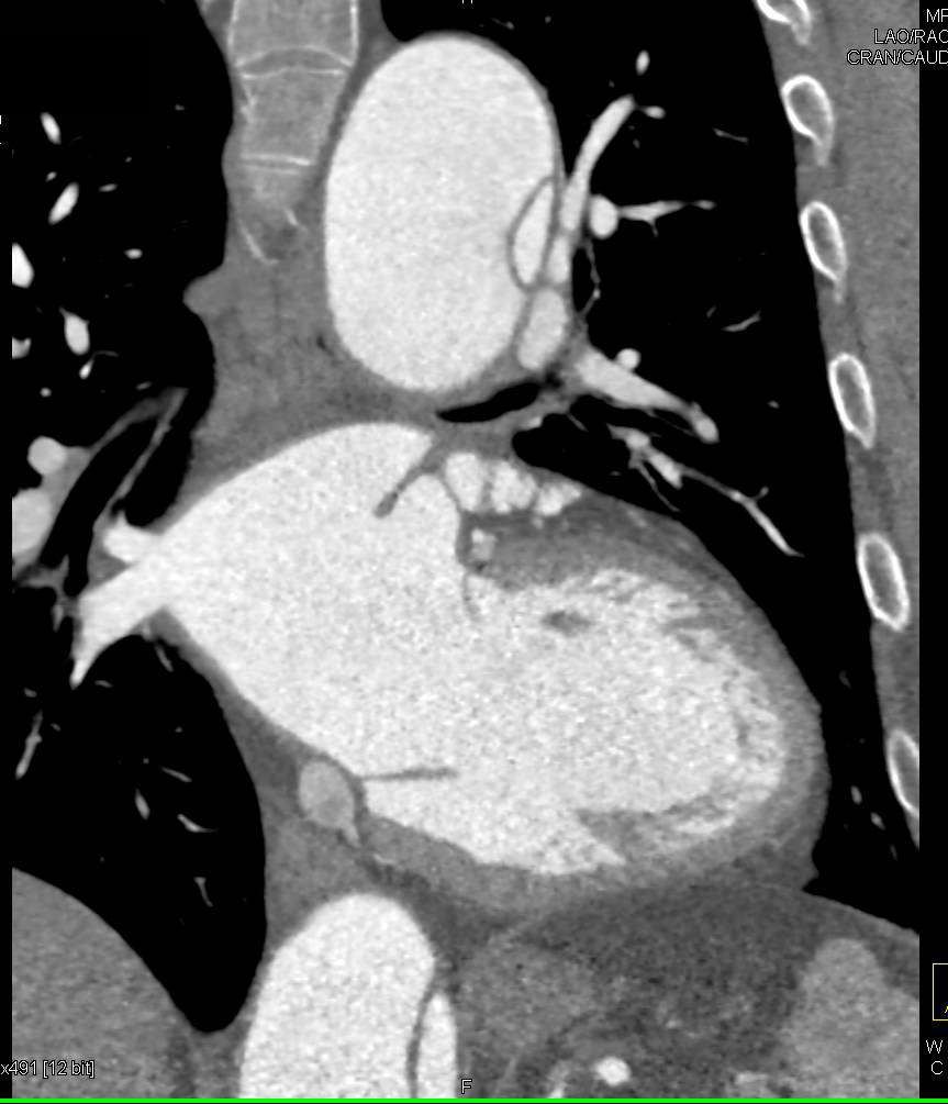 Type A Dissection with Aortic Root Repair and Dissection into the Arch Vessels - CTisus CT Scan