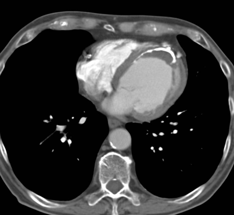 Left Ventricular Infarct - CTisus CT Scan