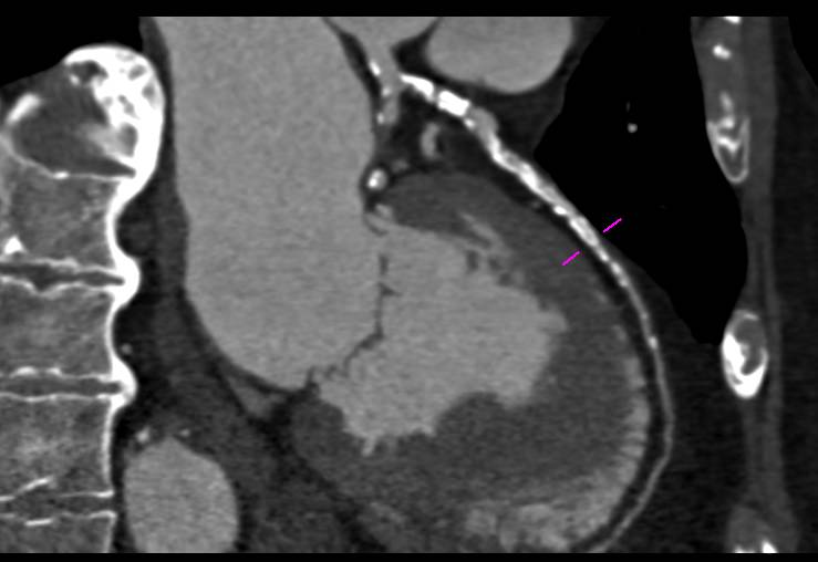 CCTA: Extensive Calcified Left Anterior Descending Coronary Artery (LAD) - CTisus CT Scan