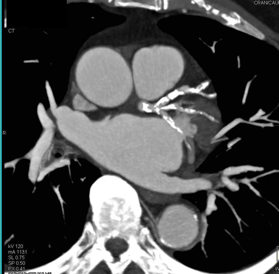 CCTA: Extensive Calcified Plaque with Multivessel Stenosis on CTA - CTisus CT Scan