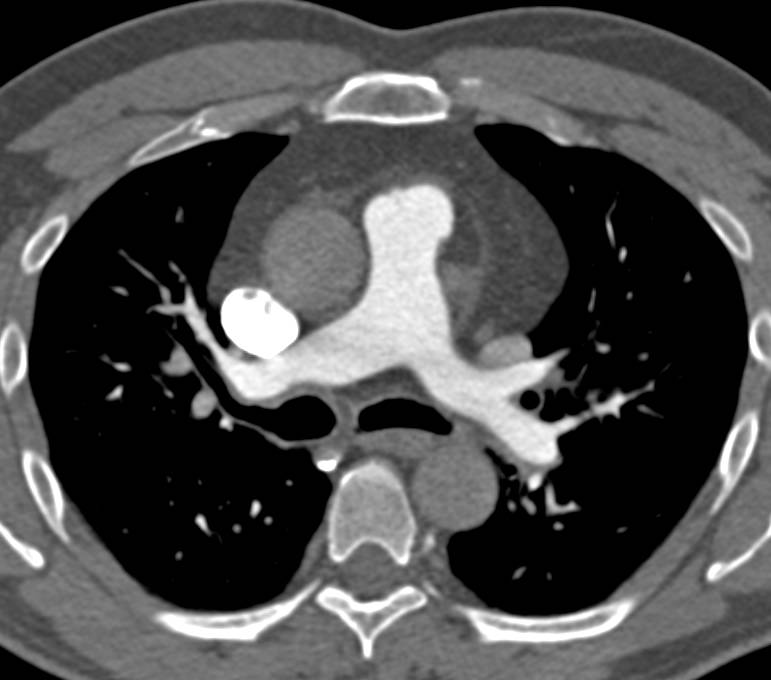 Contrast Injection Timed for Right Side of the Heart and Pulmonary Arteries - CTisus CT Scan