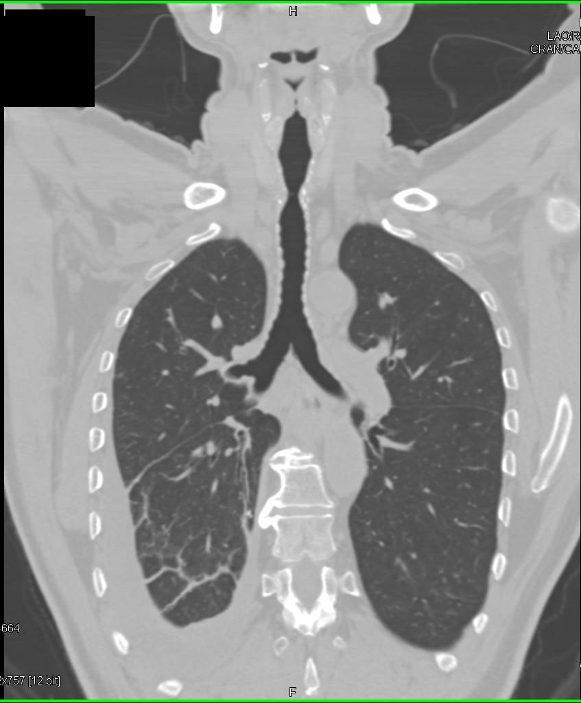 Virtual Bronchoscopy with Subglottic Stenosis due to Prior Intubation. Virtual Images Best Show Stenosis - CTisus CT Scan