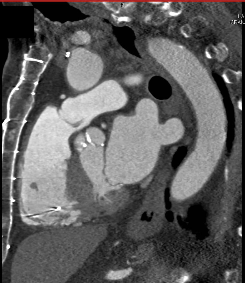 Preoperative Planning for Aortic Valve Replacement (AVR) in Patient with Prior Cardiac Surgery. Note Extensive Calcification of Aortic Valve Leaflets - CTisus CT Scan