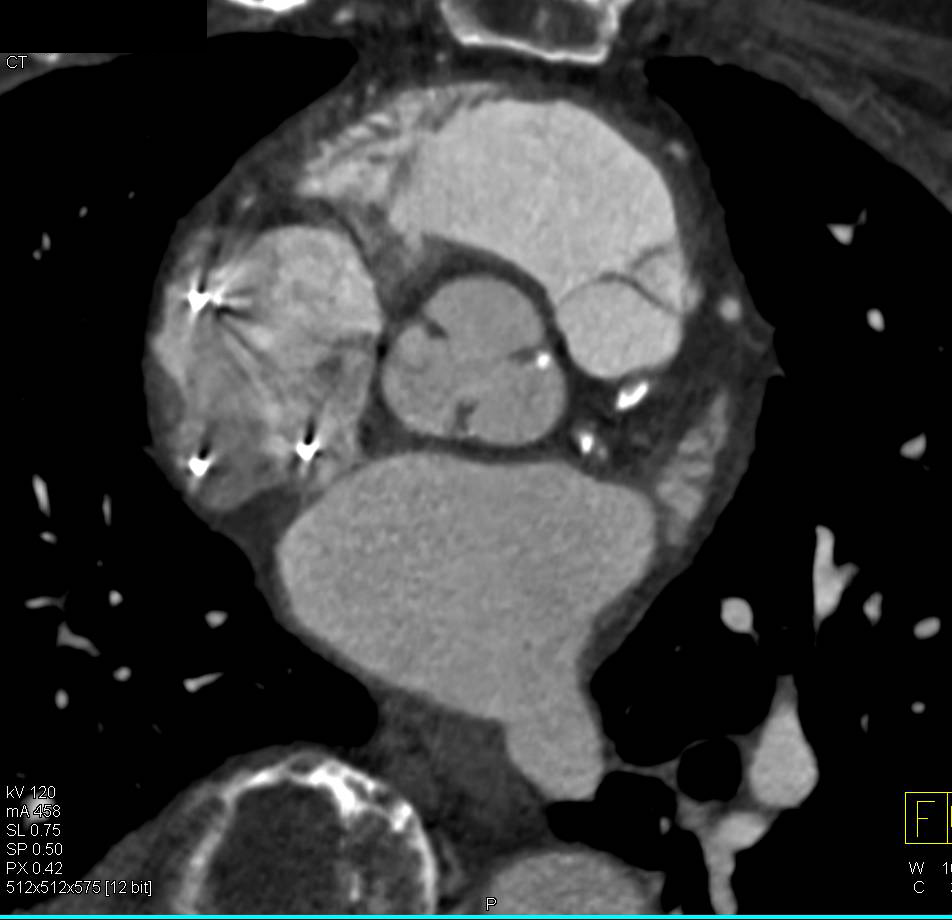 Pre-operative Planning for Aortic Valve Replacement (AVR) in Patient with Prior Coronary Artery Bypass Graft (CABG) - CTisus CT Scan