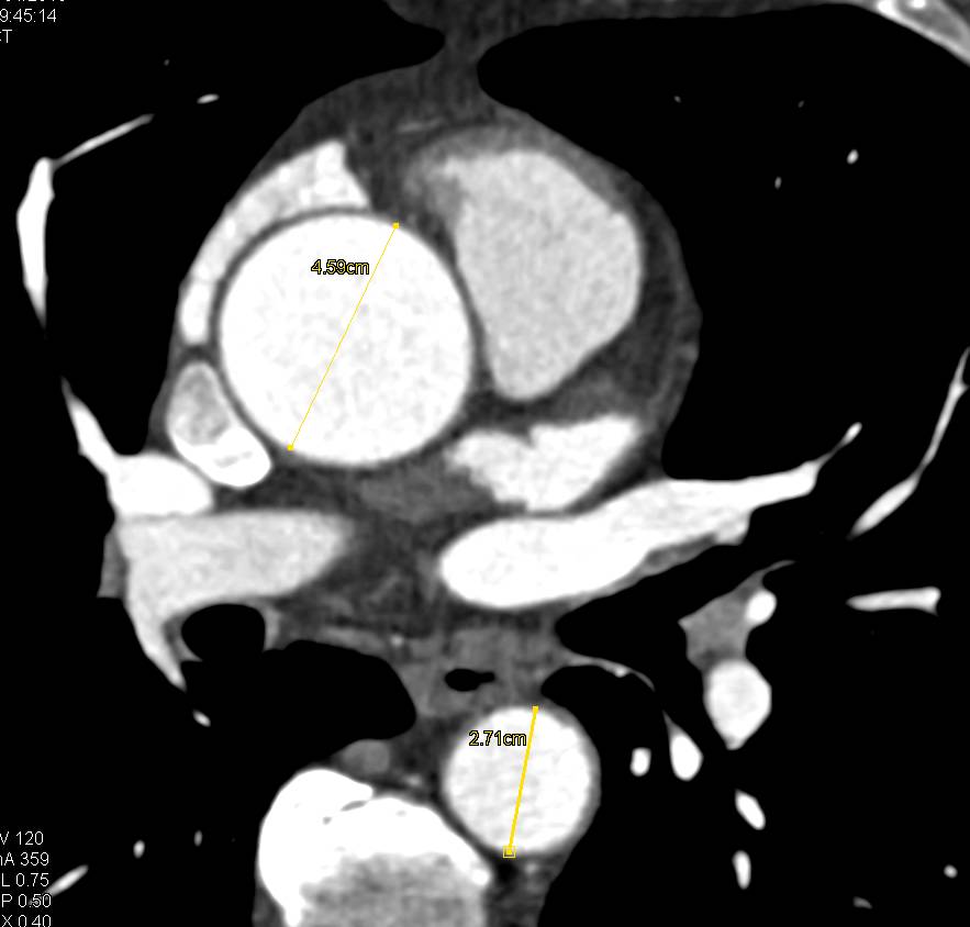 Bicuspid Aortic Valve with Dilated Ascending Aorta as well as Coronary Artery Disease with Stent in the Left Anterior Descending Artery (LAD) - CTisus CT Scan