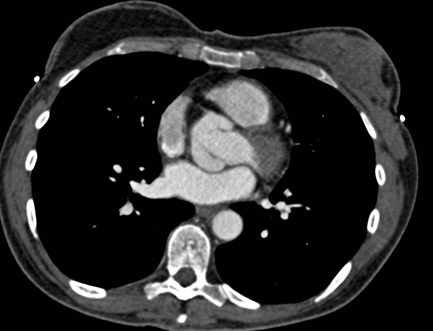 Bicuspid Aortic Valve - CTisus CT Scan