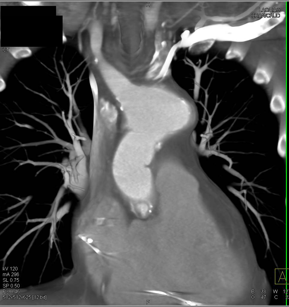 Complex Repair of Ascending Aorta, Arch and Root with Reimplantation of the Coronary Arteries - CTisus CT Scan