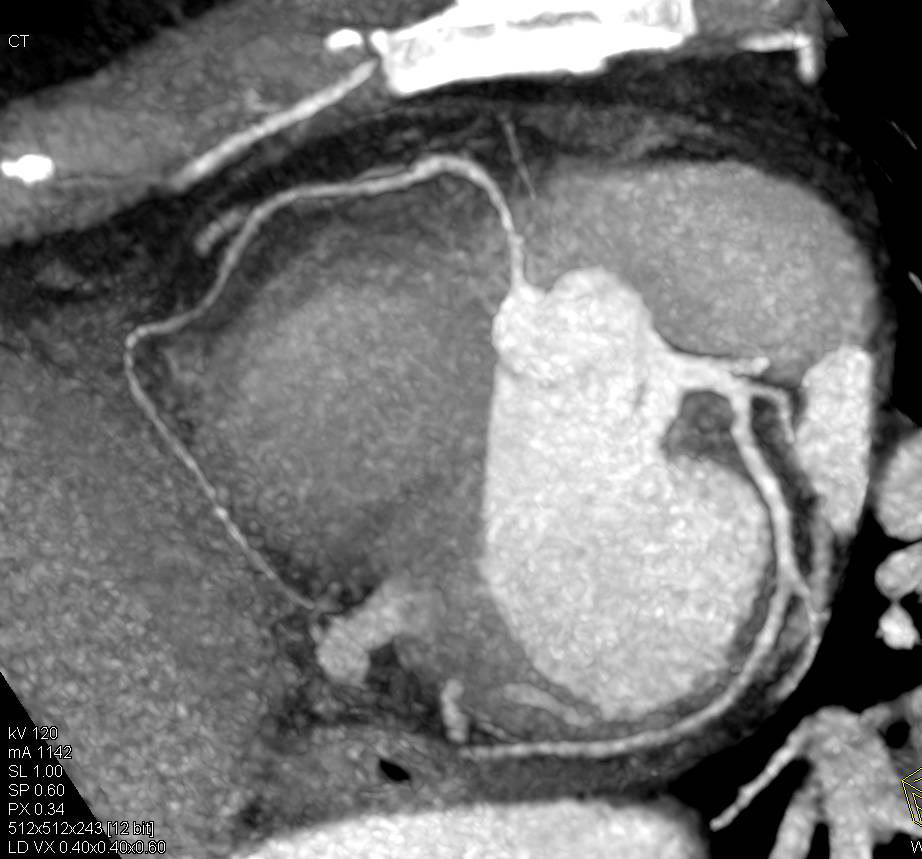 CCTA: Co-Dominant Circulation - CTisus CT Scan