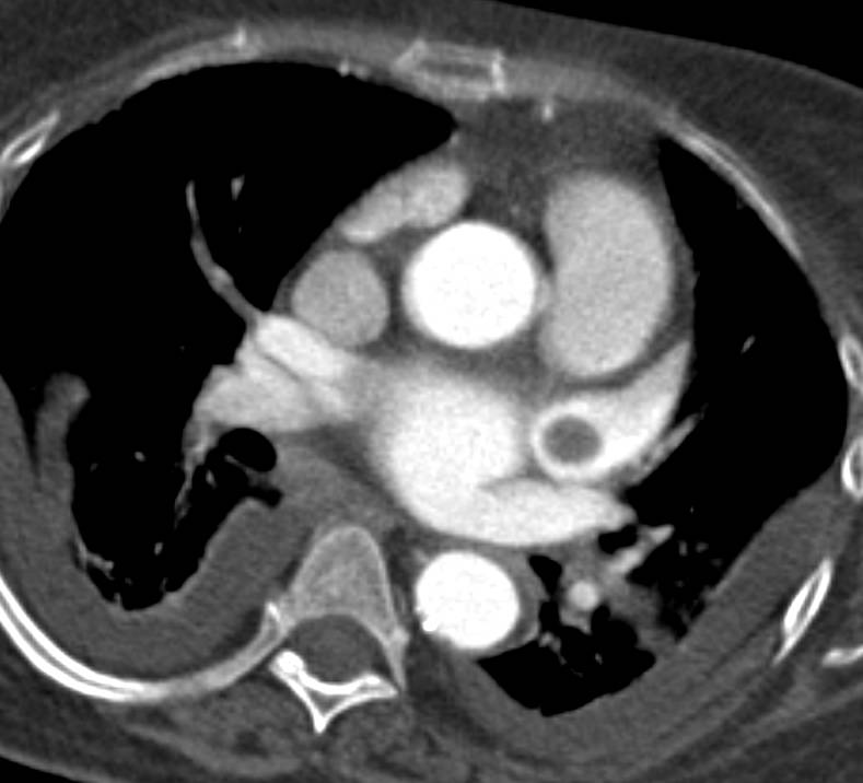 Thrombus in Left Atrial Appendage - CTisus CT Scan