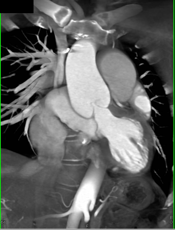 Bicuspid Aortic Valve with Dilated Ascending Aorta with Vascular Mapping - CTisus CT Scan