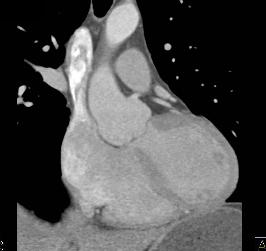 Dilated Aortic Root and Skeletal Changes Classic for Marfan - CTisus CT Scan