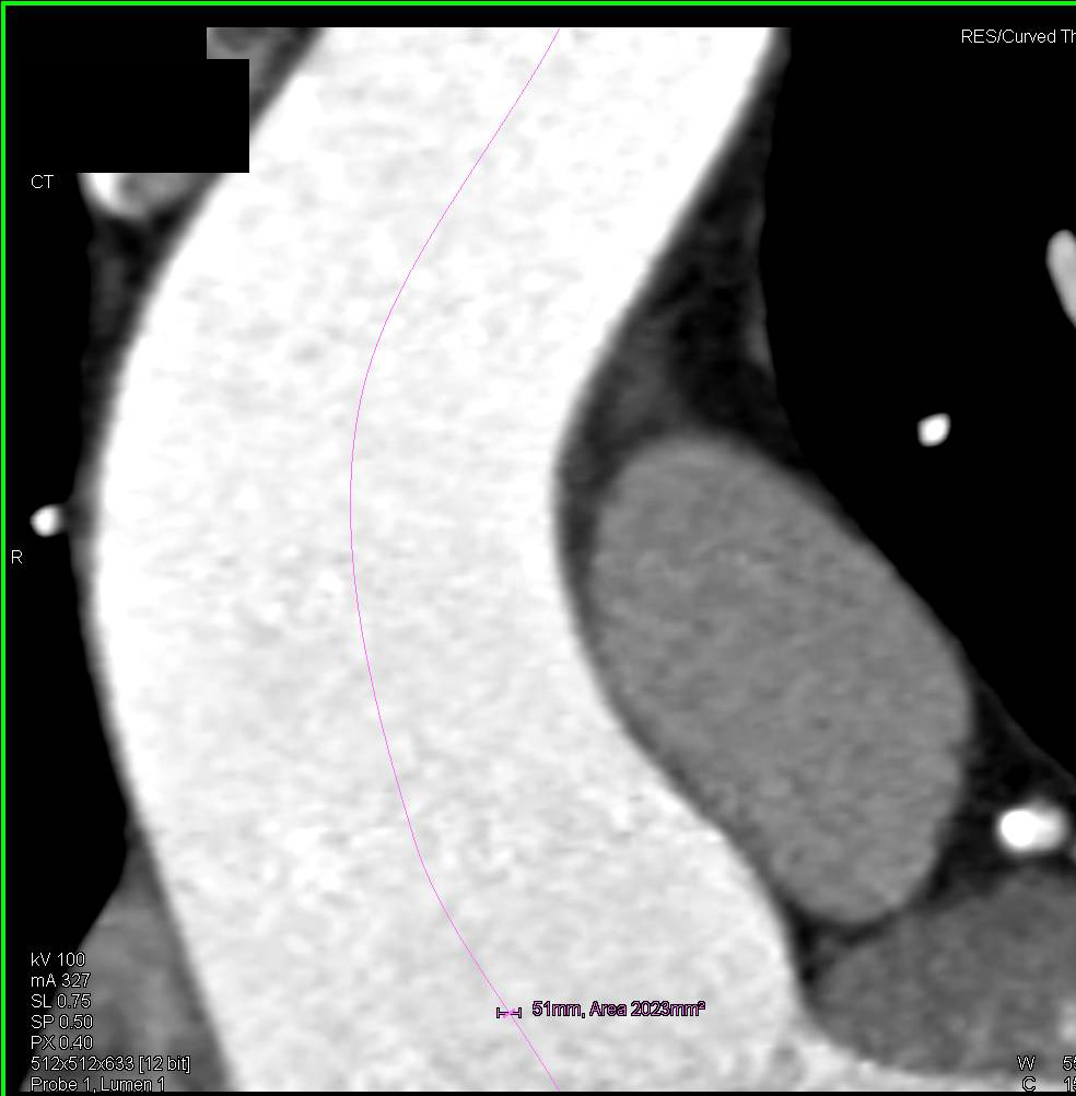 Central Line Mapping of a Dilated Ascending Aorta - CTisus CT Scan