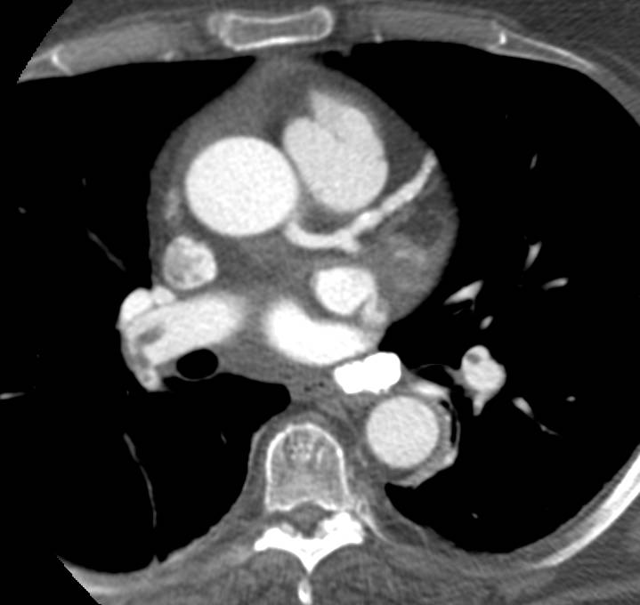 Hepatocellular Carcinoma (Hepatoma) with Metastases to the Heart and Pulmonary Emboli - CTisus CT Scan