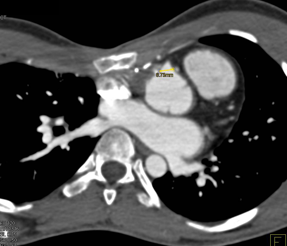 Marfan Syndrome with Root Repair and Reimplantation of Coronary ...