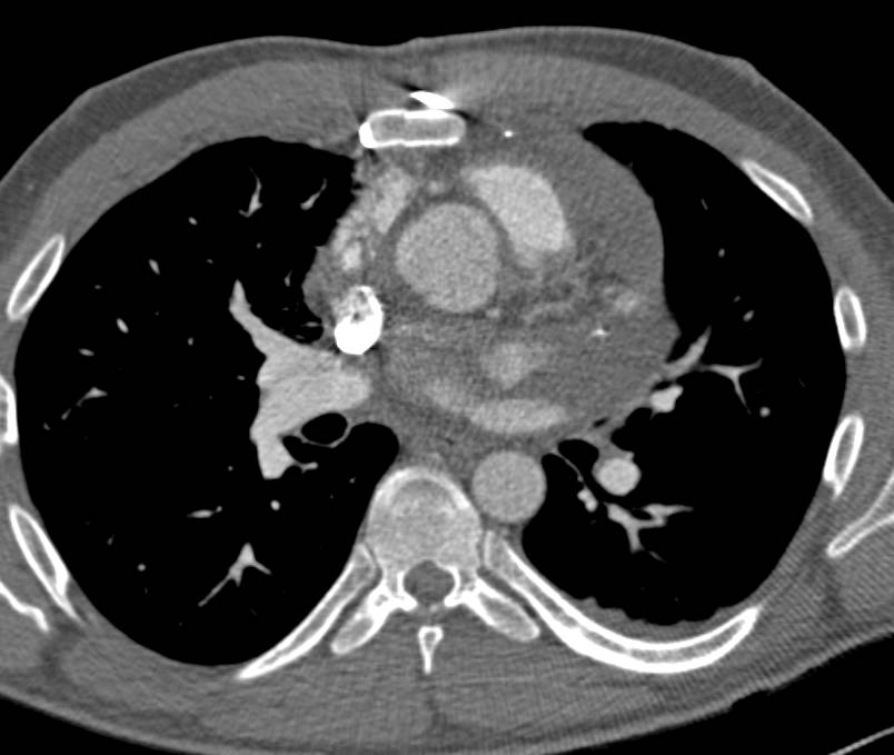 Large Pericardial Effusion Can Lead to Cardiac Tamponade - CTisus CT Scan