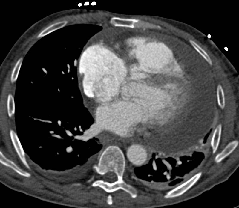 Large Pericardial Effusion - CTisus CT Scan